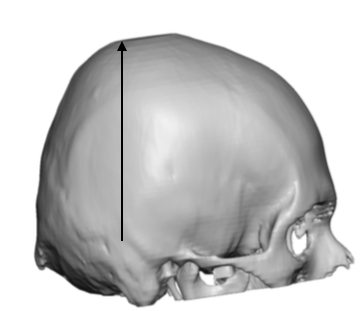 Basic Concepts in Flat Back of Head Custom Skull Implant Designs ...