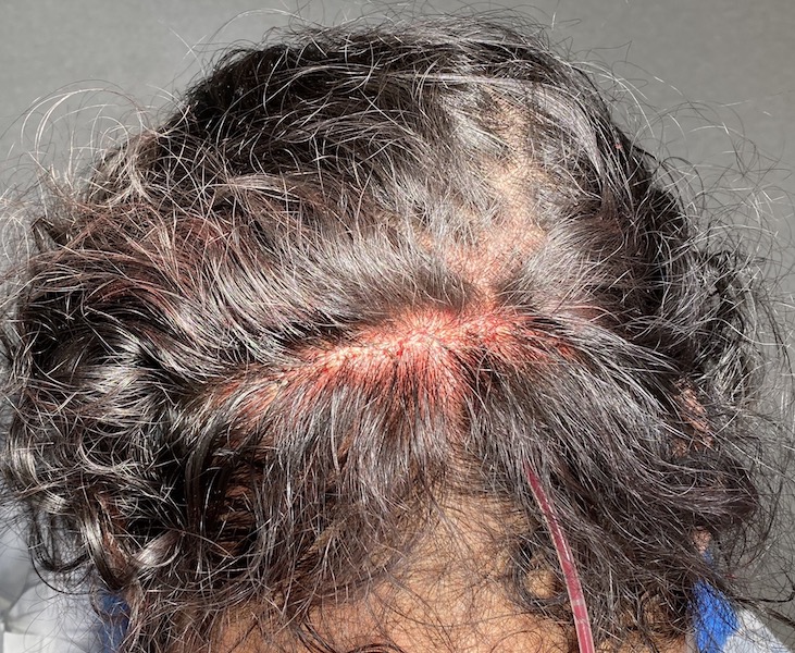 male back of head skull implant scalp closure Dr Barry Eppley ...