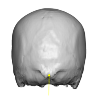 Basic Concepts in Flat Back of Head Custom Skull Implant Designs ...