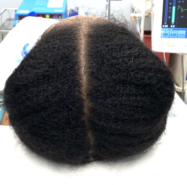 sagittal sccalp incision location aided by a midline hair part Dr Barry ...