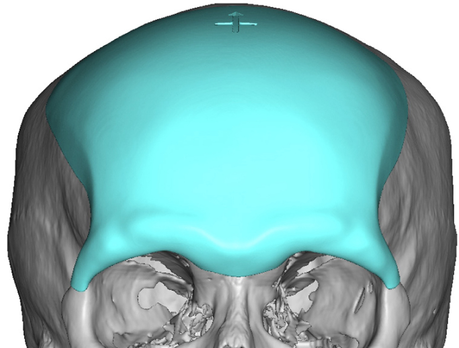 Custom Forehead-Brow Bone Implant design front view Dr Barry Eppley ...