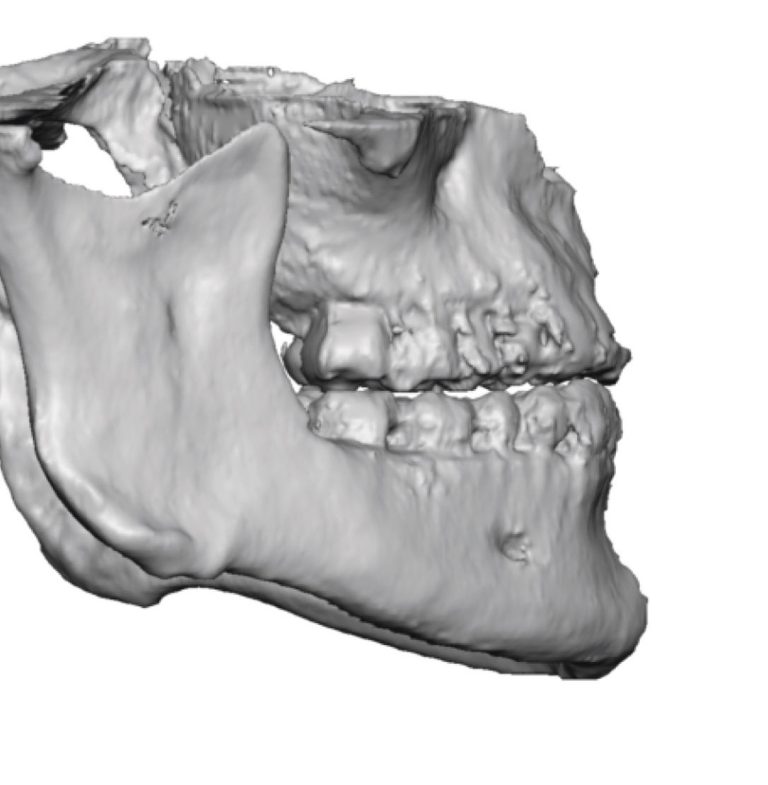 Design Considerations In Square Chin Implants - Explore Plastic Surgery