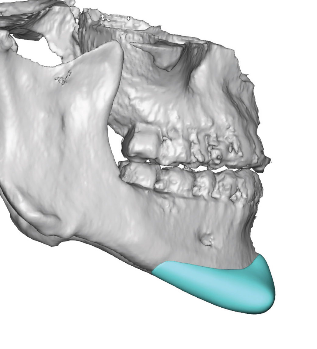 Design Considerations in Square Chin Implants - Explore Plastic Surgery