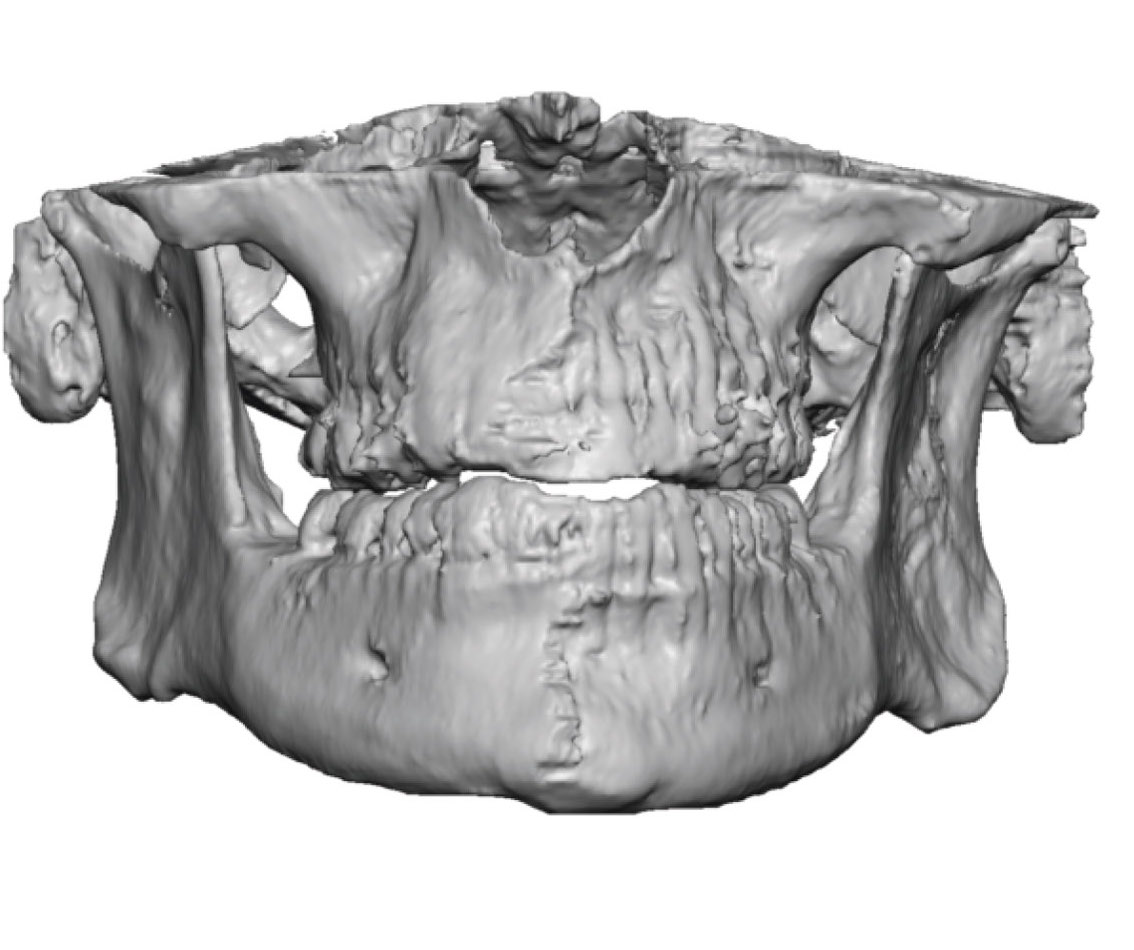 Male square chin implant design front view Dr Barry Eppley Indianapolis ...