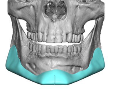 custom angular jawline implant design front view Dr Barry Eppley ...