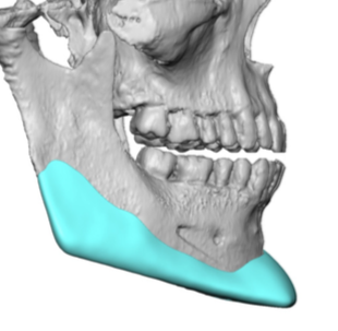 custom angular jawline implant design side view Dr Barry Eppley ...