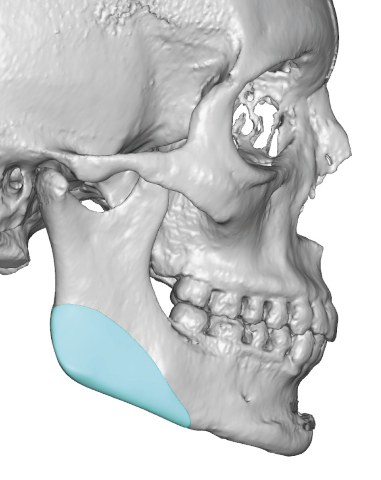 Plastic Surgery Case Study - Female Custom Jaw Angle Implants after a ...