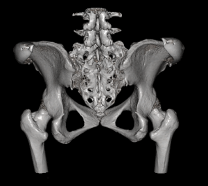 Technical Strategies - Screw Fixation of Iliac Crest Implants