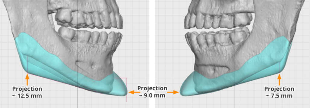 male angular custom jawline implant design dimensions Dr Barry Eppley ...