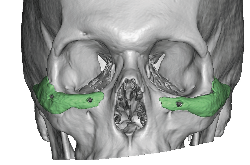 Male Custom Infraorbital Implats Front View 3d Ct Scan Dr Barry Eppley