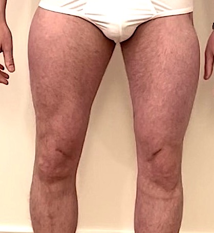 Outcome for Aesthetic Upper Leg Augmentation with Four (4) Thigh