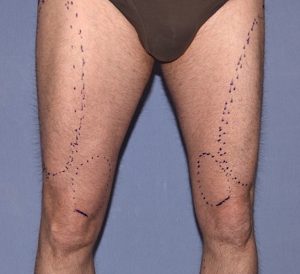 Outcome for Aesthetic Upper Leg Augmentation with Four (4) Thigh Implants -  Explore Plastic Surgery