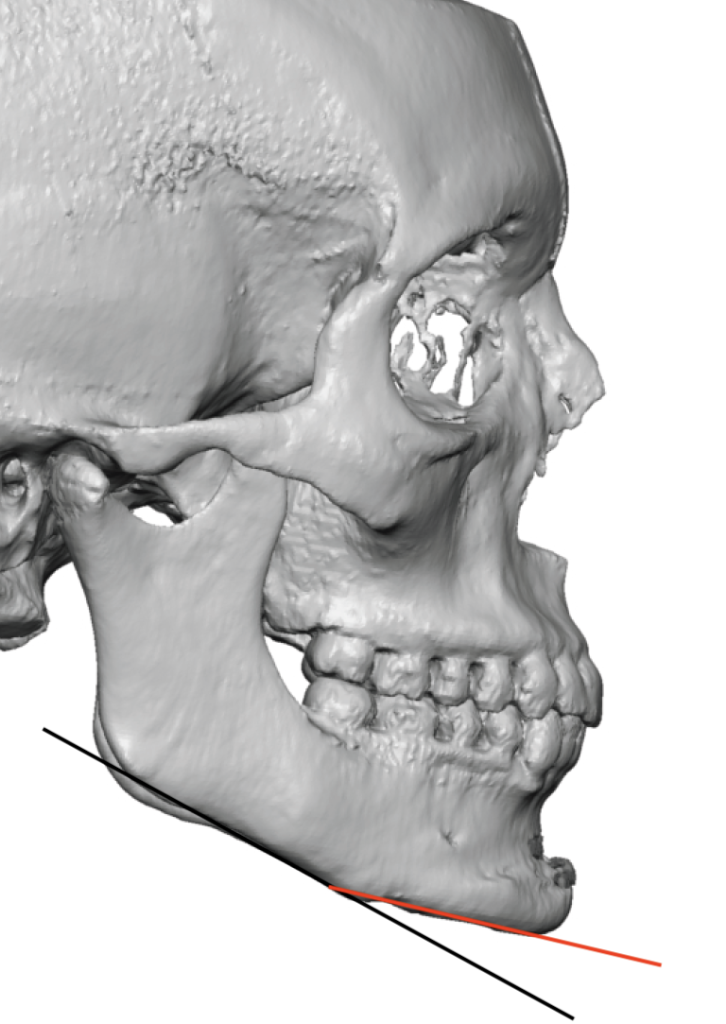 Plastic Surgery Case Study - Female Custom Jaw Angle Implants after a ...