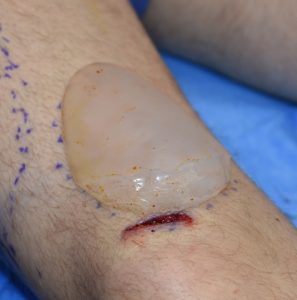 Outcome for Aesthetic Upper Leg Augmentation with Four (4) Thigh