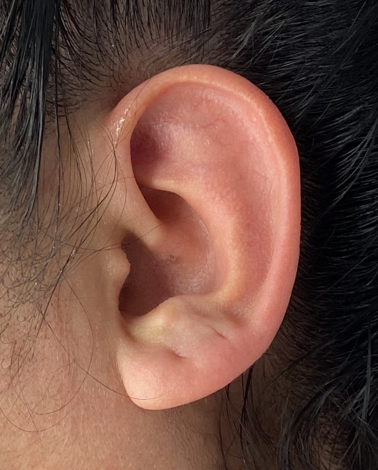 Plastic Surgery Case Study - Secondary Otoplasty Surgery For Maximum ...