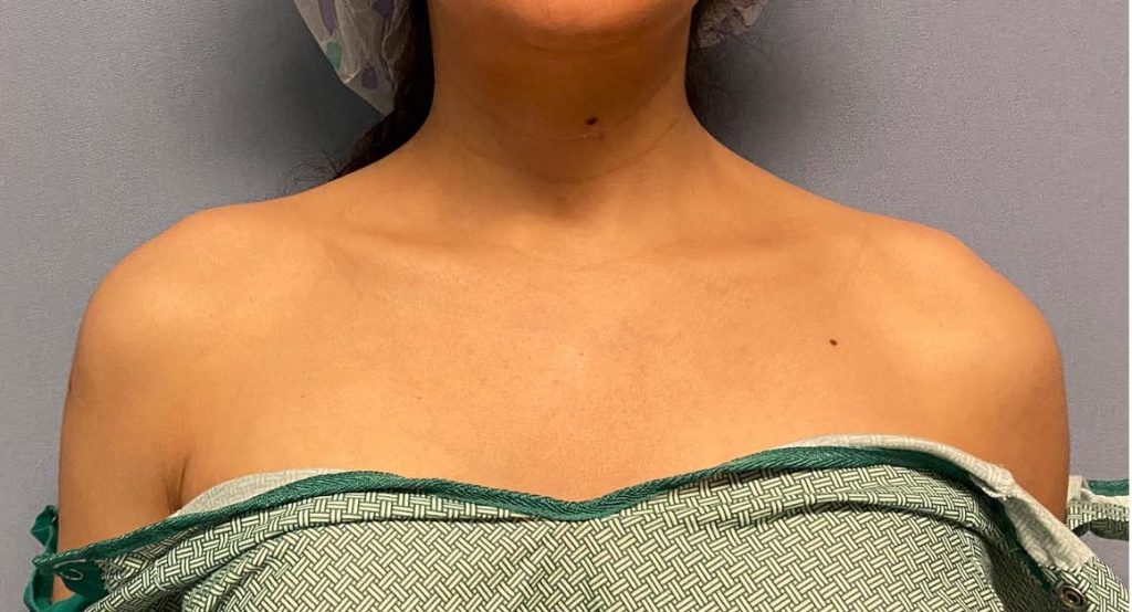 The Immediate Effects of Shoulder Narrowing Surgery Explore Plastic