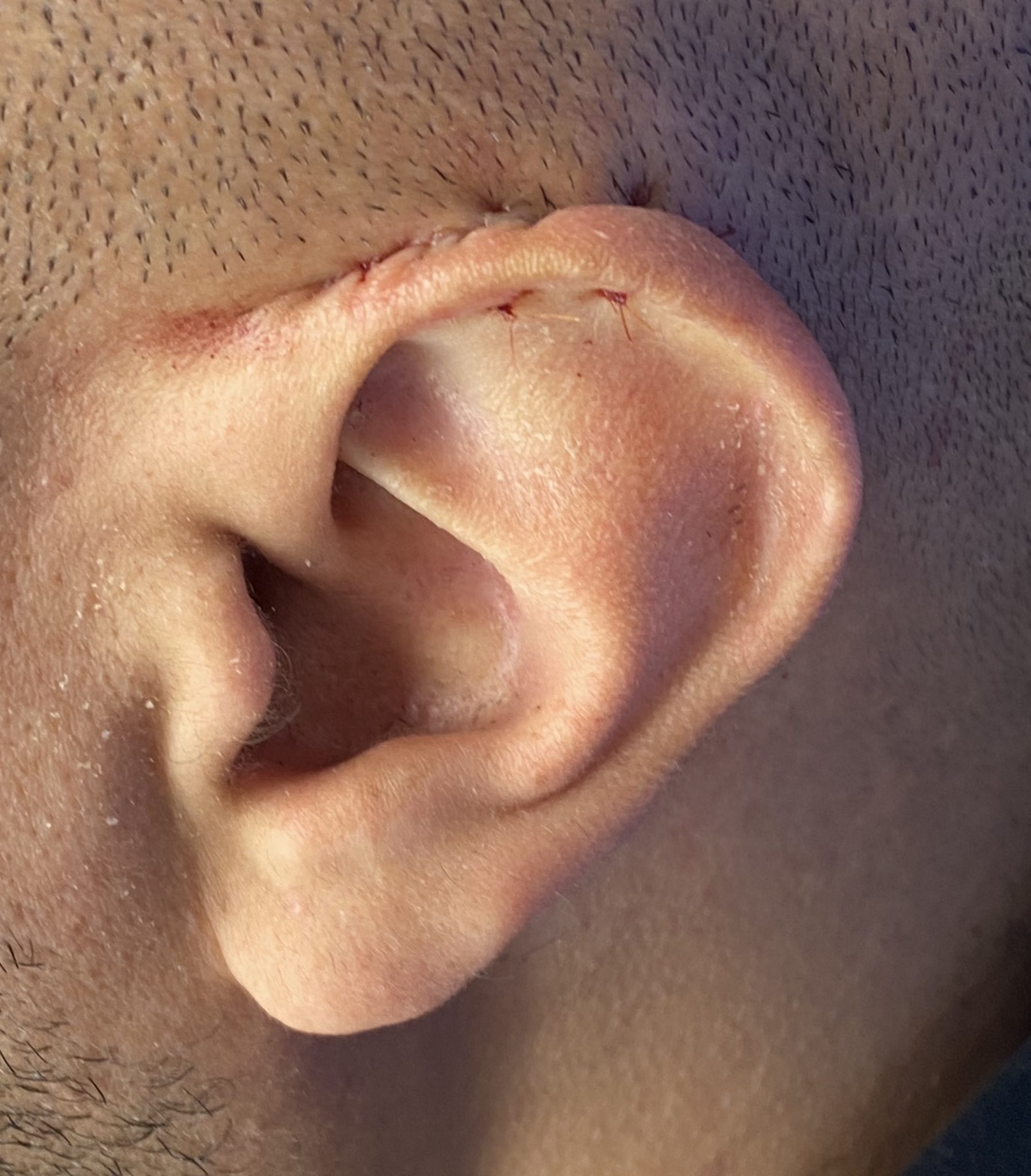 left ear extreme setback bolster sutures Dr Barry Eppley Indianapolis