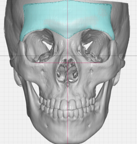 Female Custom Brow Bone Implant Design Front View Dr Barry Eppley 