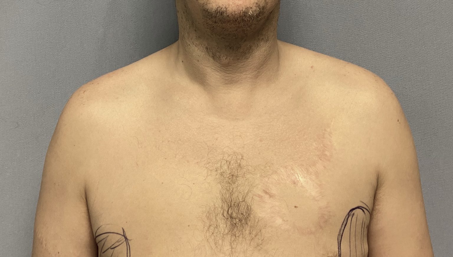 male clavicle lengthening front 1 Dr Barry Eppley Indianapolis