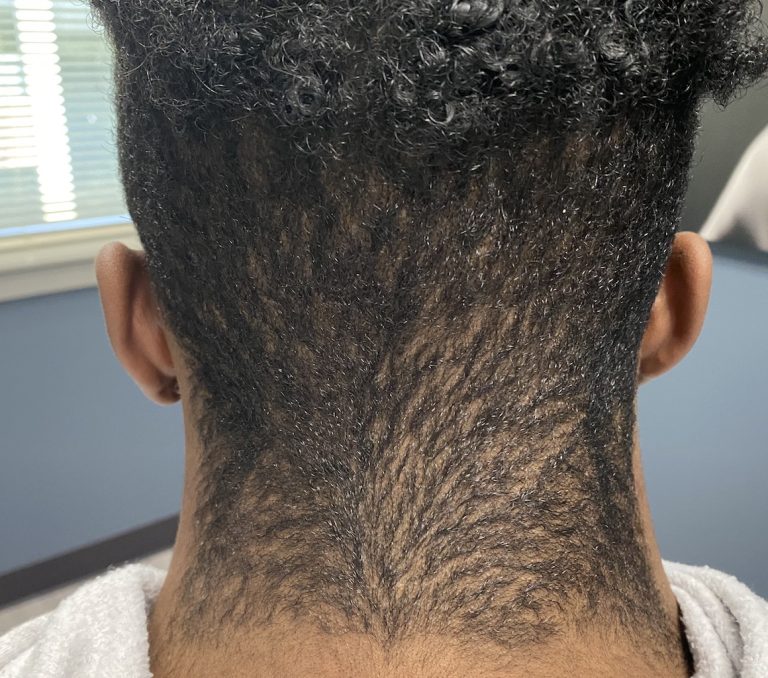 male webbed neck with low hairline Dr Barry Eppley Indianapolis