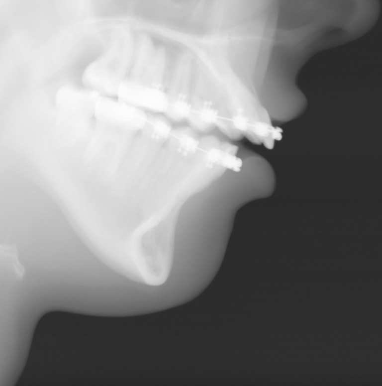 Plastic Surgery Case Study Sliding Genioplasty with Soft Tissue