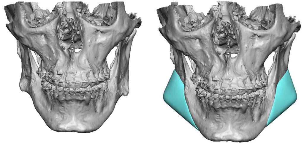 Jaw Asymmetry As An Indication For Custom Jaw Angle Implant Designs ...