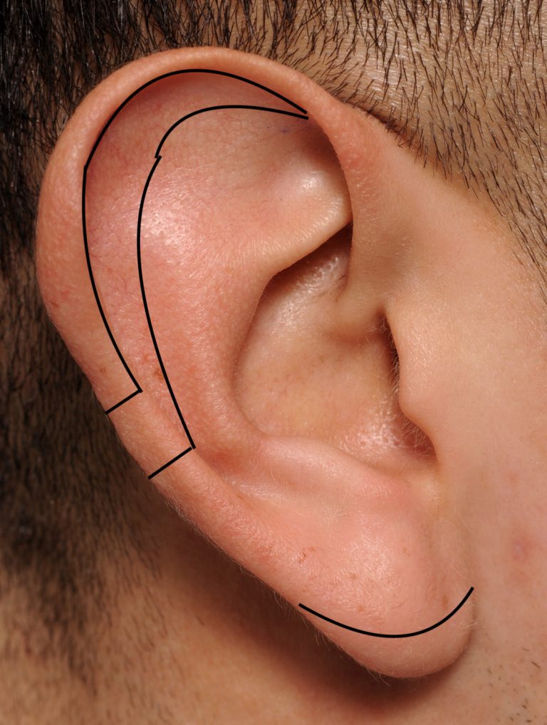 Plastic Surgery Case Study Central Wedge Resection Technique For Plastic Surgery Case Study Central Wedge Resection Technique For