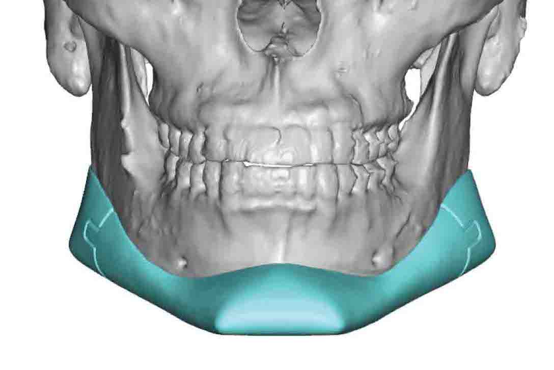 Male custom jawline implantb replacement design front view Dr Barry ...