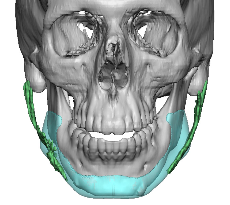 custom implant design vs injectable filler 3D CT scan front view Dr ...