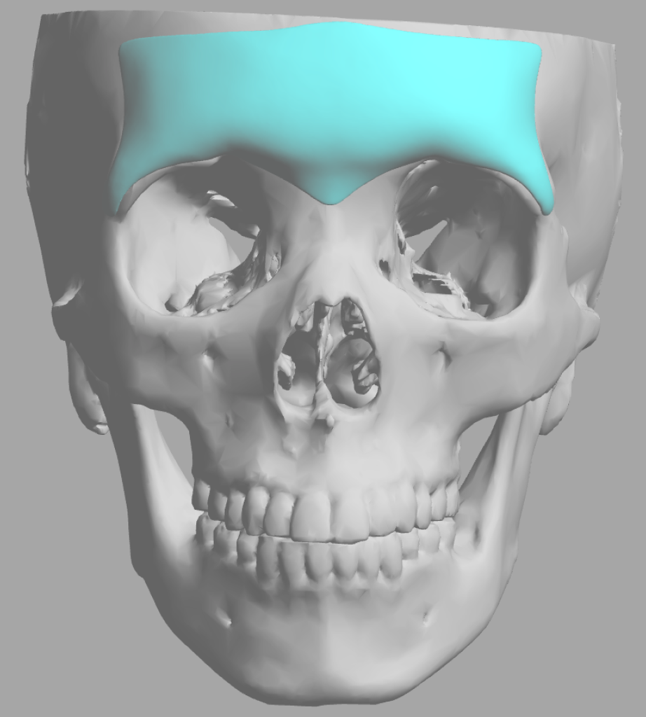 Gender Differences in Custom Brow Bone Implant Designs - Explore ...