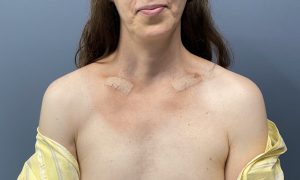 broad shoulders with no clavicle show Dr Barry Eppley copy - Explore  Plastic Surgery