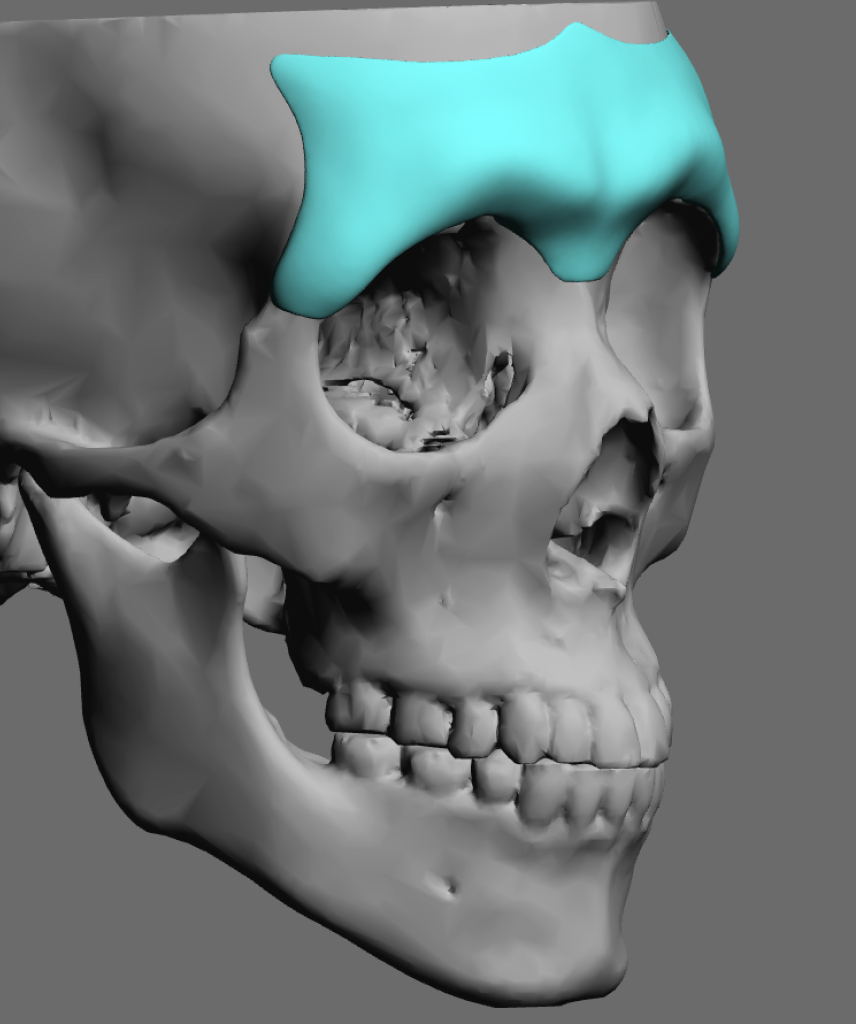 Gender Differences in Custom Brow Bone Implant Designs Explore