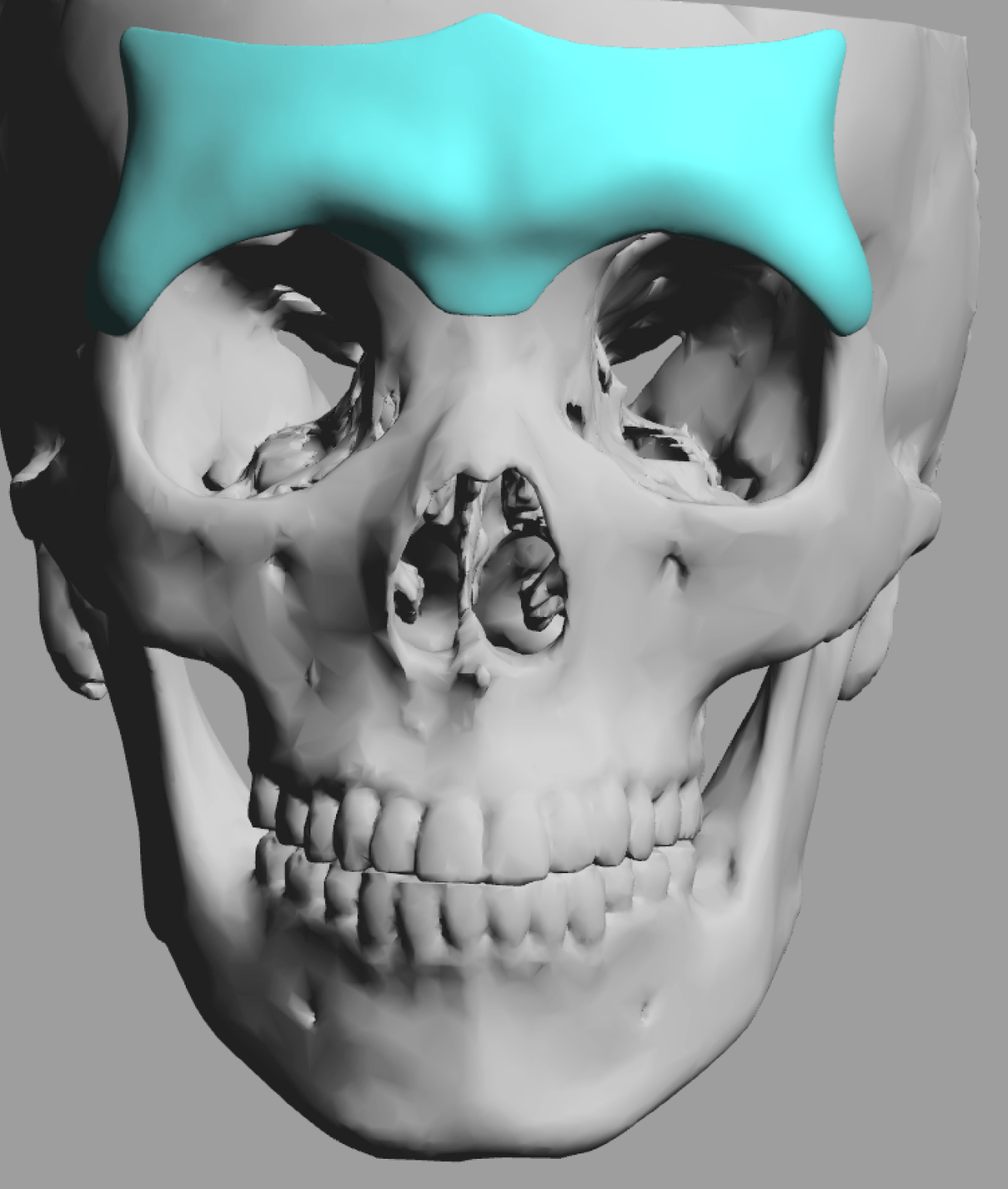 Gender Differences in Custom Brow Bone Implant Designs - Explore ...