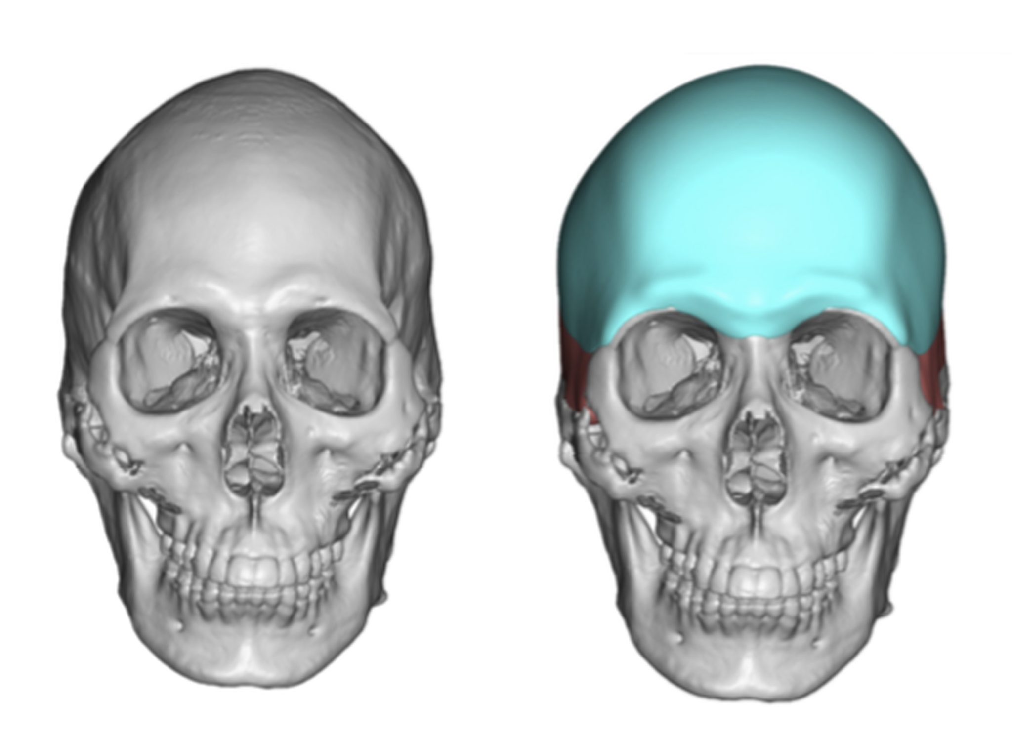 male custom forehead brow bone implant design front view Dr Barry