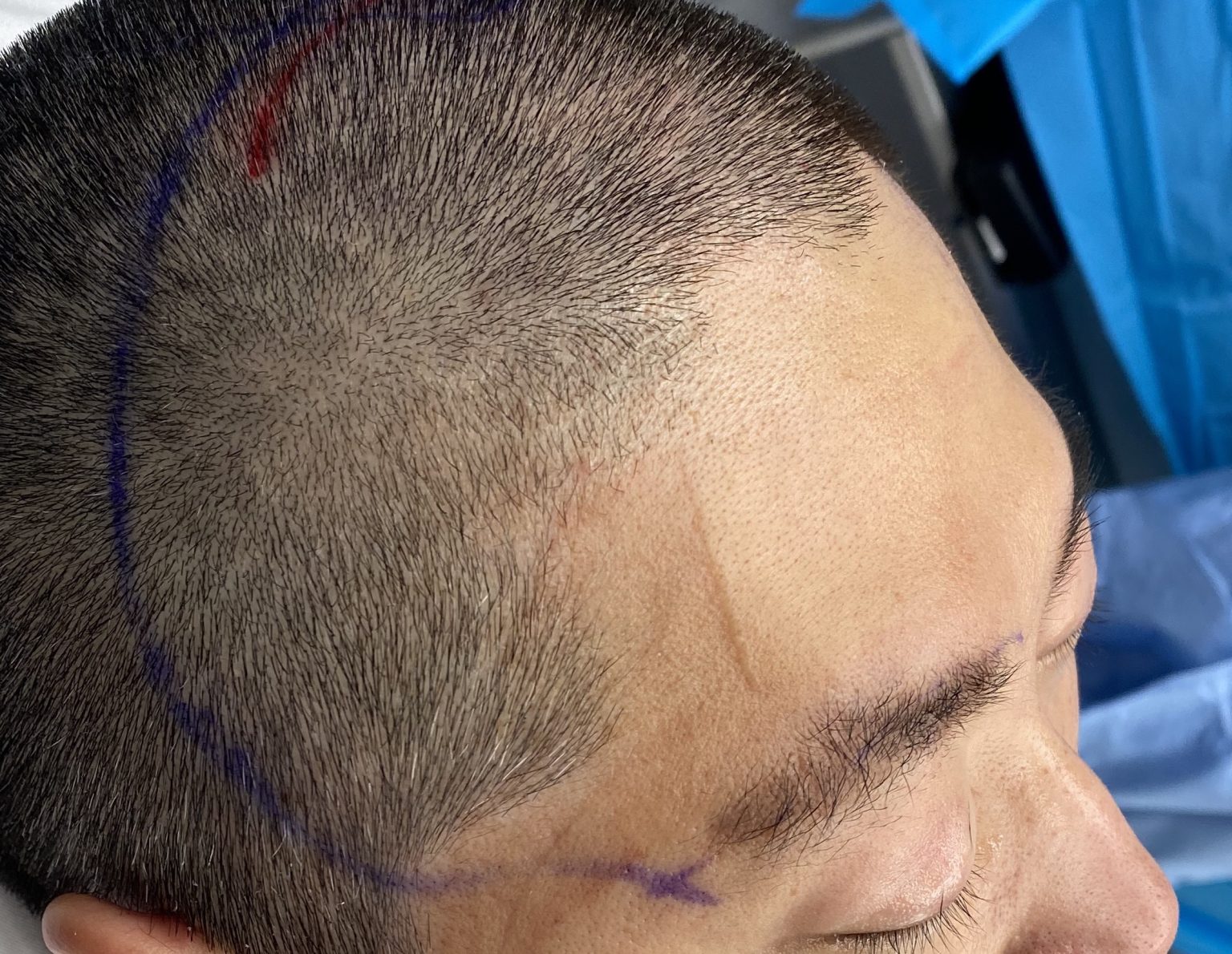 male custom forehead brow bone implant oblique 1 Dr Barry Eppley