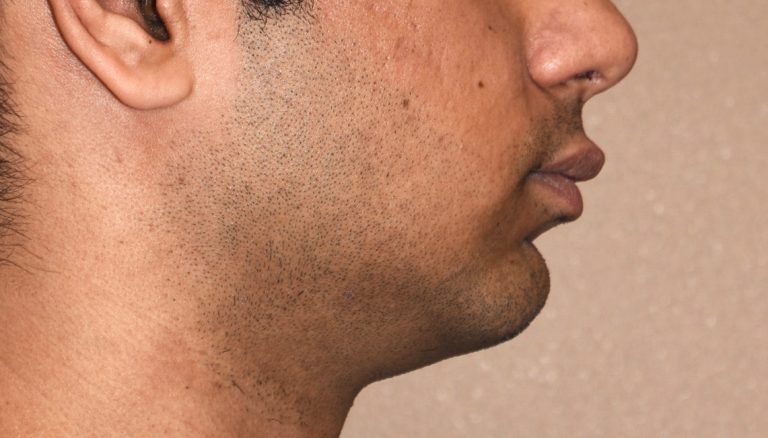 wraparound jaw implant