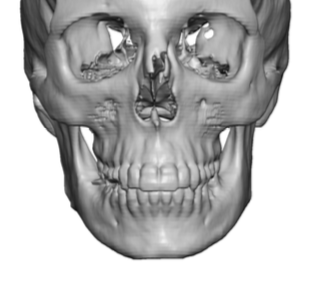 Technical Strategies - Submental Inferior Border Shave in Jaw Asymmetry ...