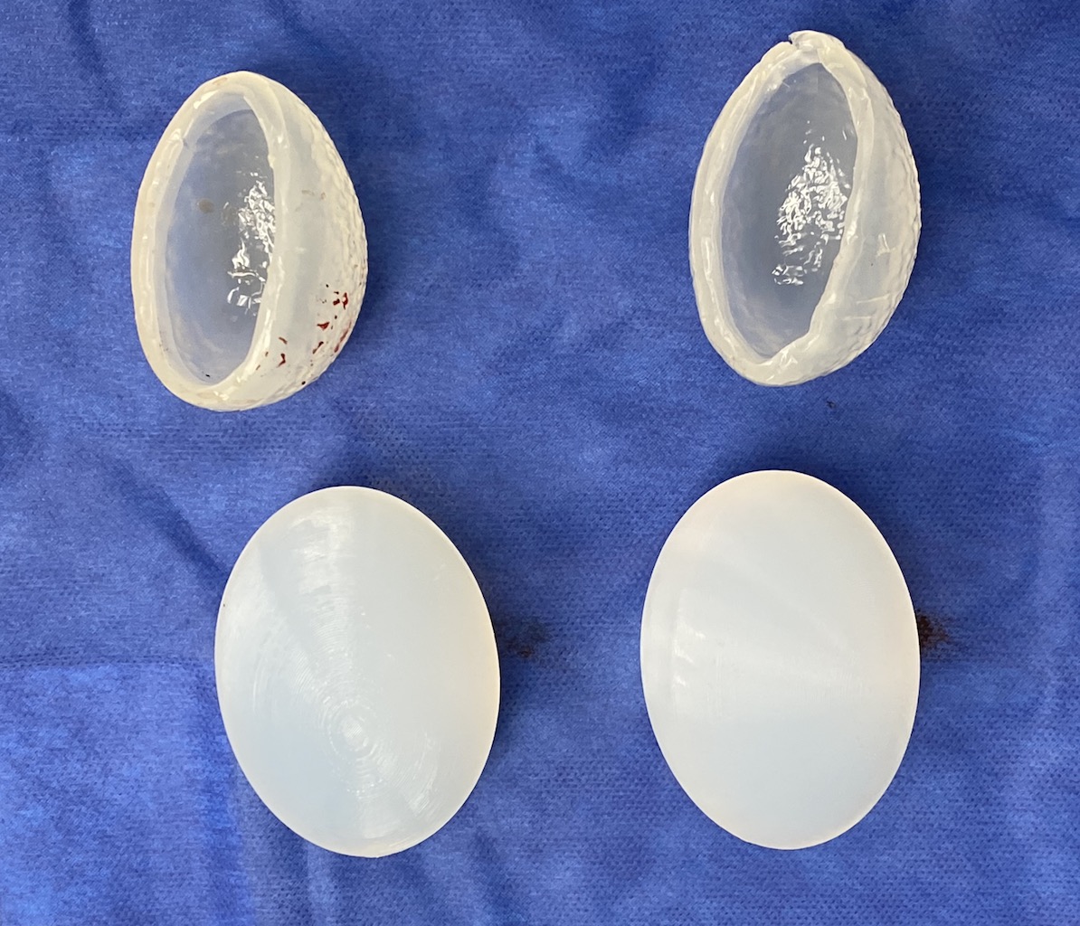 Solid Xl Testicle Implan Replacements Vs Cupped Testicle Implants Dr Barry Eppley Indianapolis