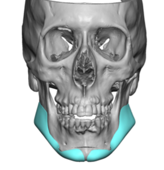 make sliding genioplasty with custom jawline implants front view 2 Dr ...