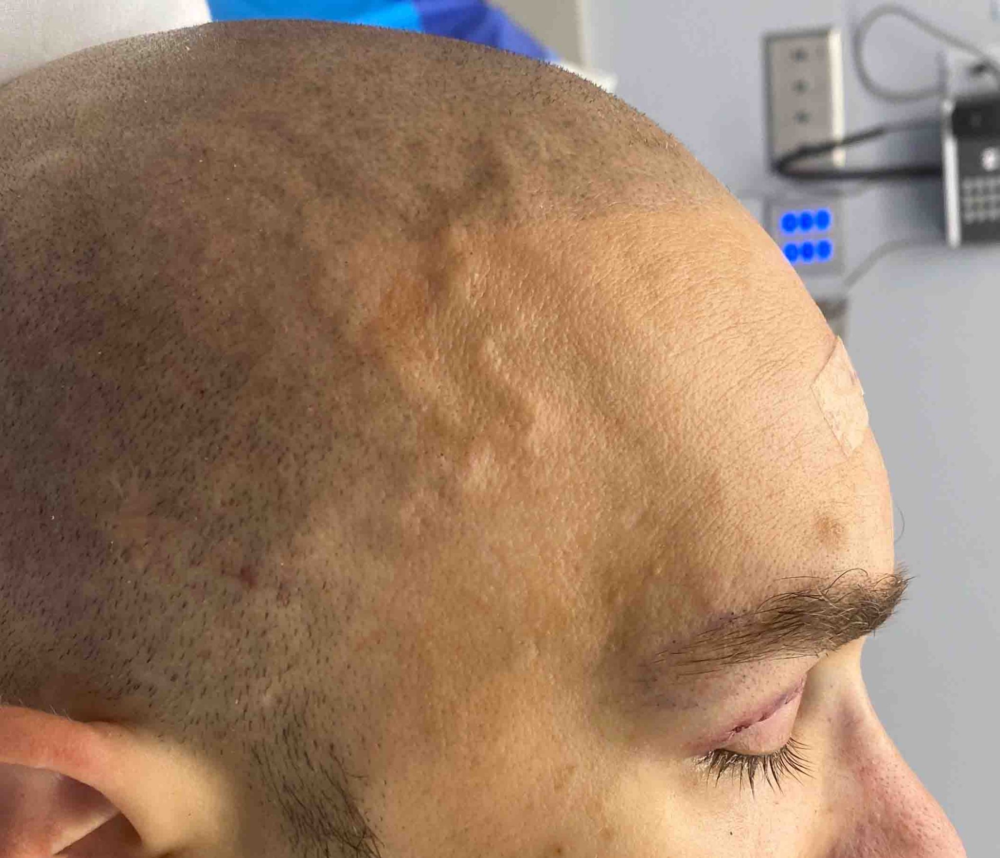 Plastic Surgery Case Study MidForehead Approach to the Shaved Head