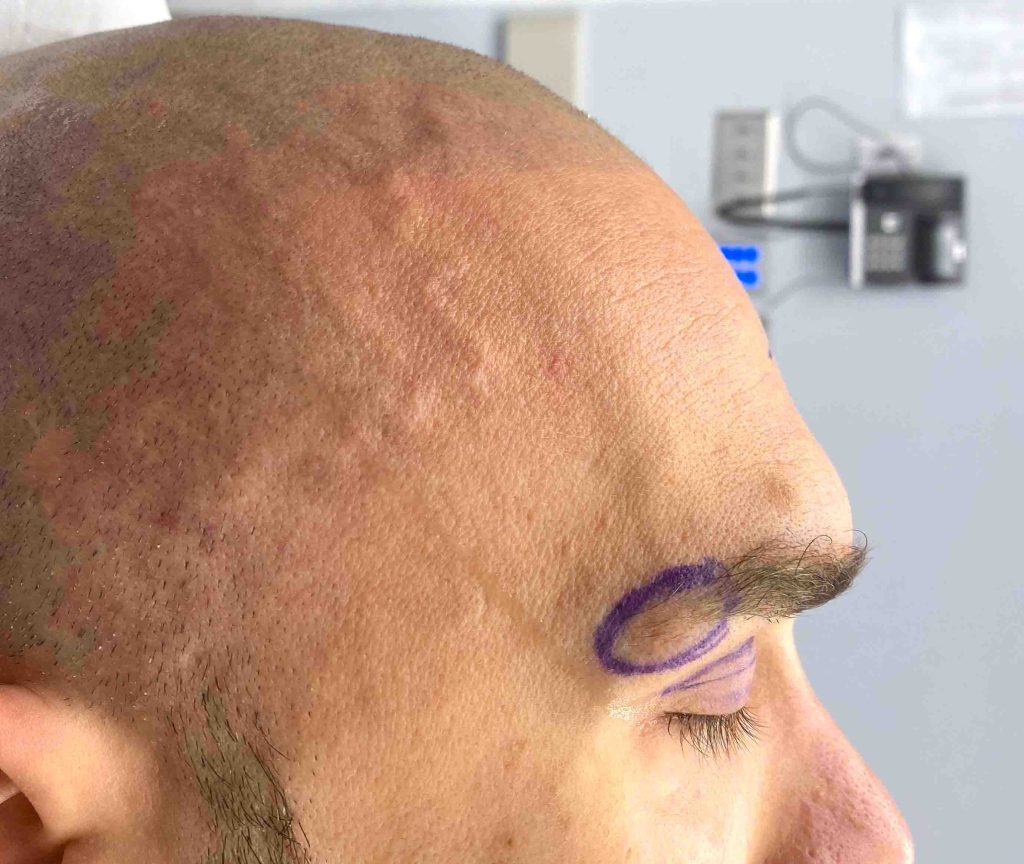 Plastic Surgery Case Study MidForehead Approach to the Shaved Head