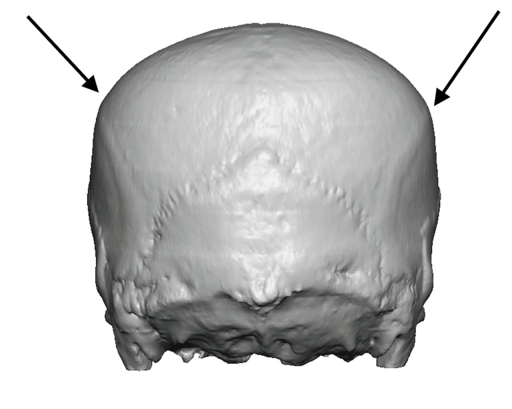 Plastic Surgery Case Study - Total Flat Back Of Head Reshaping With ...