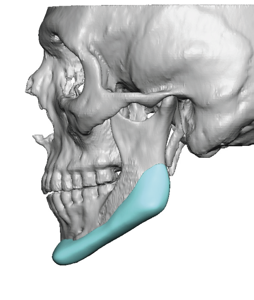 custom jawline imlant replacement design side view Dr Barry Eppley ...