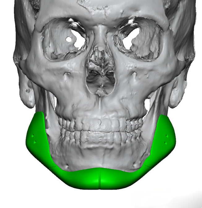 custom jawline implant design front view Dr Barry Eppley - Explore ...