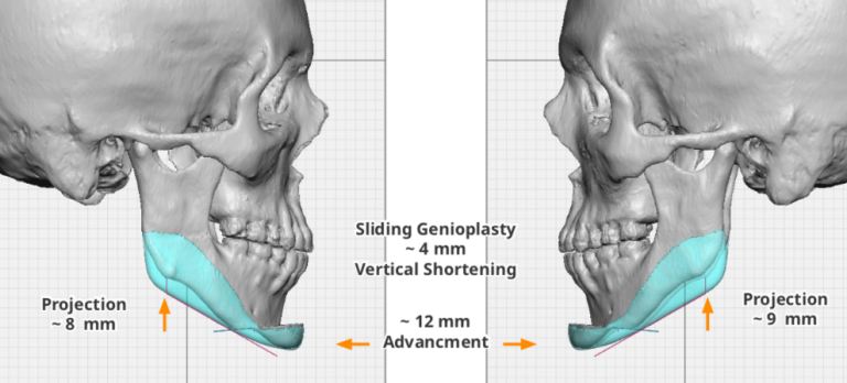 Plastic Surgery Case Study - Reshaping/Derotating The Steep Mandibular ...