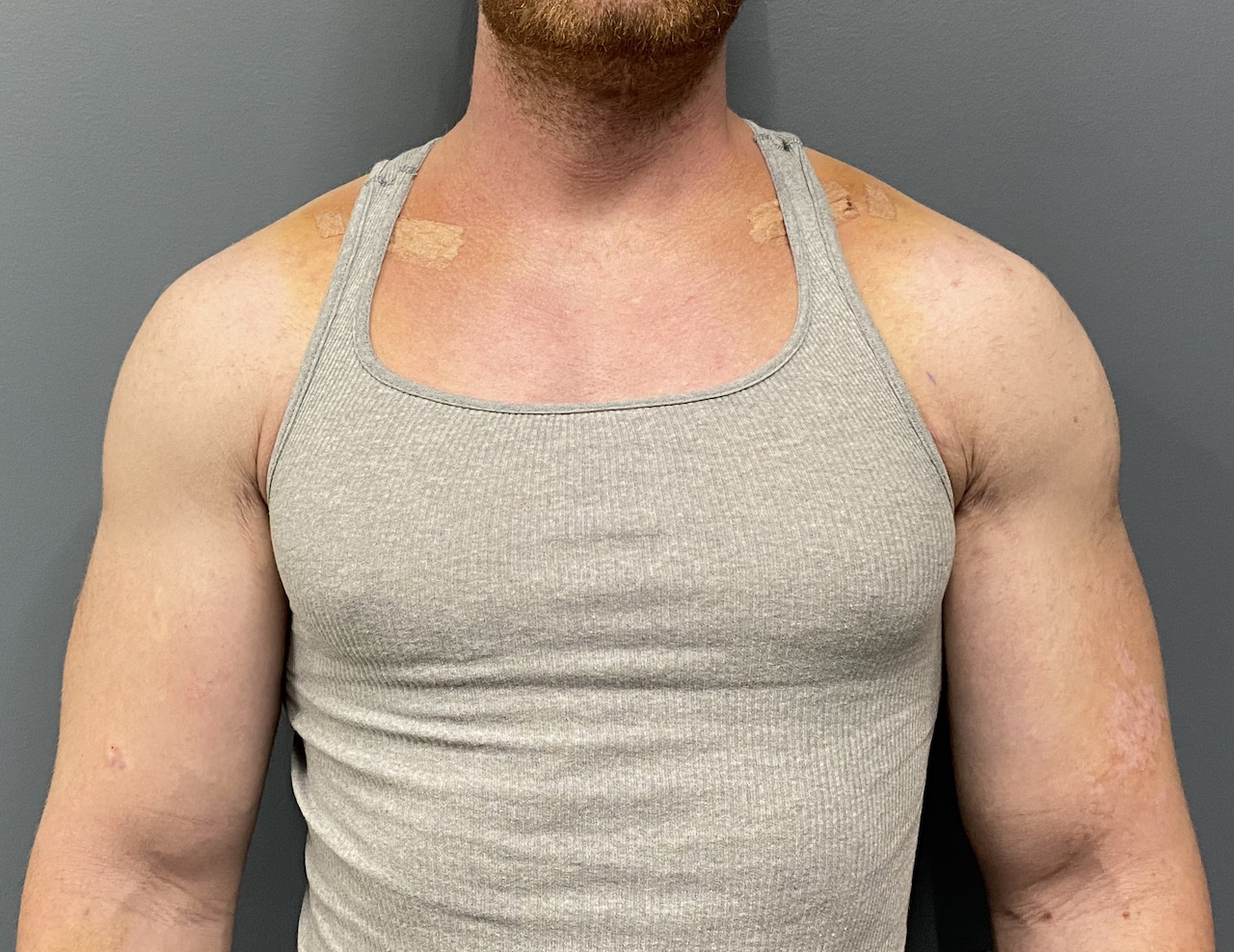 Plastic Surgery Case Study - Shoulder Widening By Clavicle Lengthening