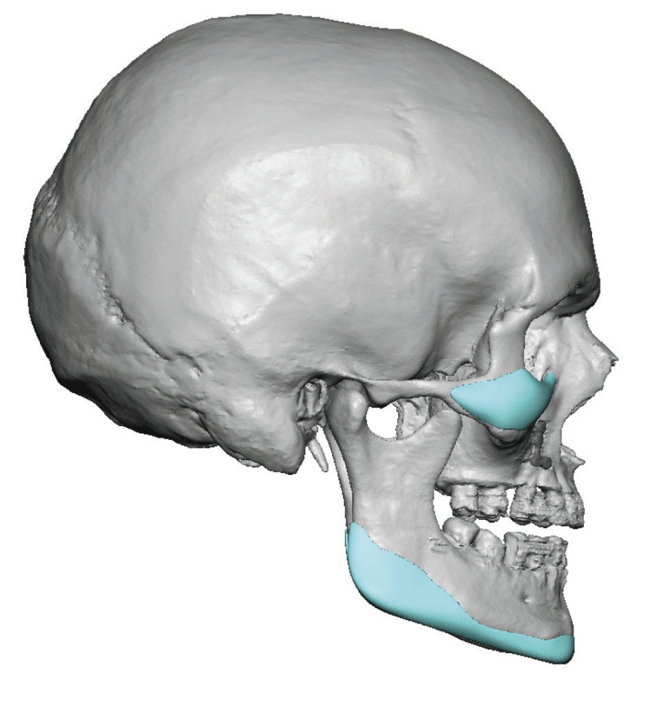 male custom IOM and jawline implants design side view Dr Barry Eppley ...