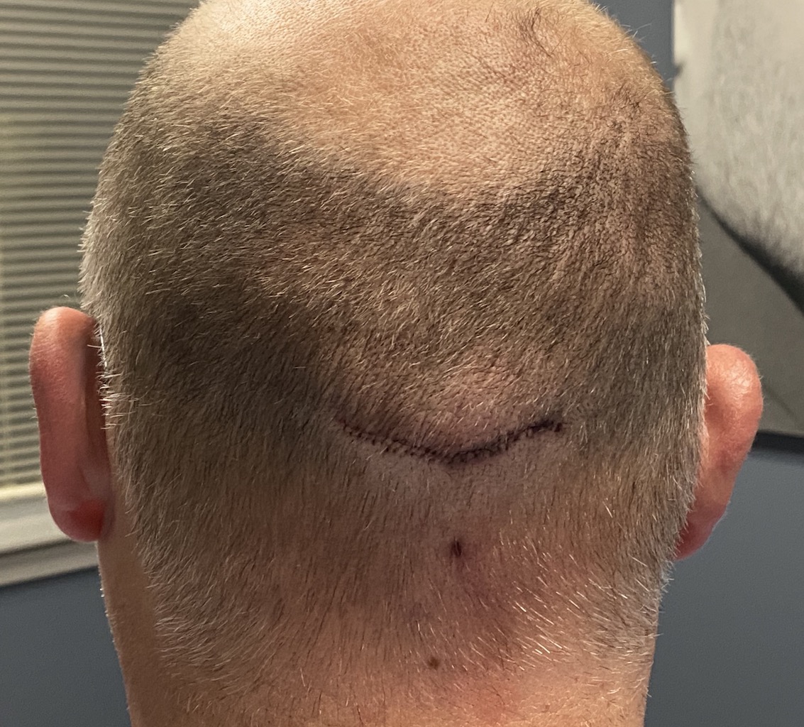 One Day After Reduction Of Large Occipital Knob And Nuchal Ridges Dr