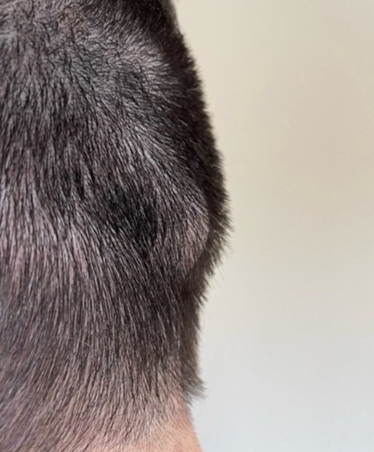 Prominent Occipital Knob In A Male With Hair Side View Dr Barry Eppley