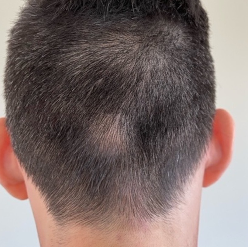 Plastic Surgery Case Study Occipital Knob Skull Reduction in a Thin